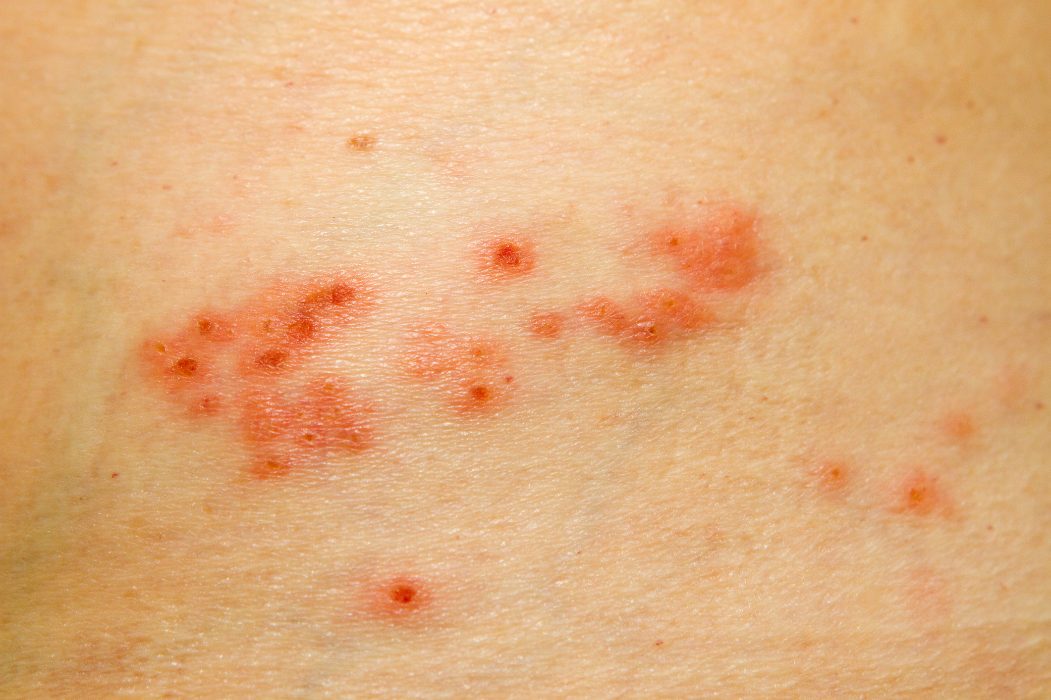 how long after shingles does the pain last